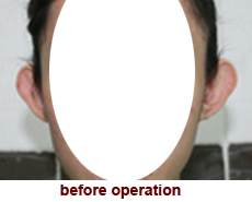 plastic-surgery-prominent-ear 